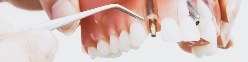 Szczęka z implantami zębowymi